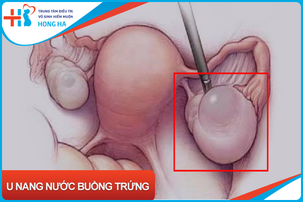 U nang nước buồng trứng: Tác động của chúng đến sức khỏe phụ nữ
