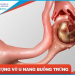 U nang buồng trứng xuất huyết: Nguyên nhân, triệu chứng và cách phòng tránh