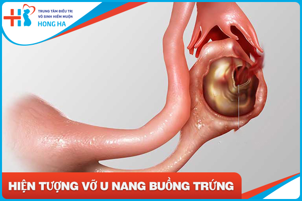 U nang buồng trứng xuất huyết: Nguyên nhân, triệu chứng và cách phòng tránh