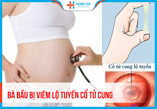 Viêm lộ tuyến cổ tử cung ở bà bầu: Triệu chứng và cách điều trị