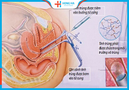 Cận cảnh Phương pháp bơm tinh trùng iui