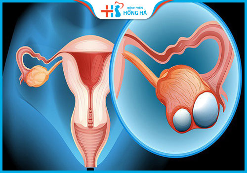 u nang buồng trứng lành tính và ác tính