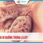 U nang bì buồng trứng: Nguyên nhân, triệu chứng và phương pháp điều trị