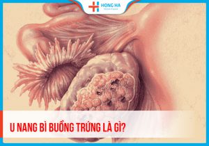 U nang bì buồng trứng: Nguyên nhân, triệu chứng và phương pháp điều trị