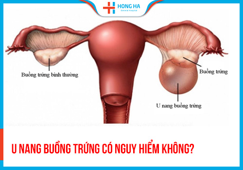 U nang buồng trứng có nguy hiểm không