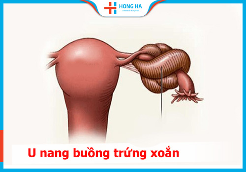 Phương pháp điều trị u nang buồng trứng xoắn hiệu quả nhất