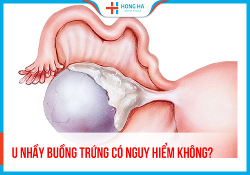 U nang nhầy buồng trứng: Nguyên nhân, triệu chứng và điều trị