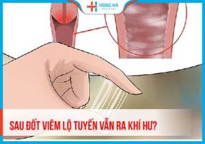 Khí hư sau điều trị đốt viêm lộ tuyến: Nguyên nhân và cách khắc phục