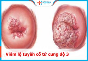 Phương pháp chữa trị hiệu quả cho viêm lộ tuyến cổ tử cung cấp độ 3