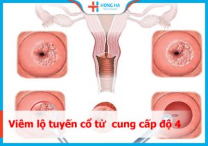 Viêm lộ tuyến cấp độ 4: Nguyên nhân, triệu chứng và điều trị hiệu quả