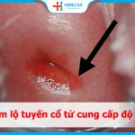 Cách chẩn đoán và điều trị viêm lộ tuyến cấp độ 1 hiệu quả nhất