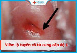Cách chẩn đoán và điều trị viêm lộ tuyến cấp độ 1 hiệu quả nhất