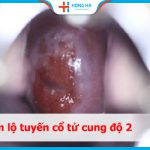 Các triệu chứng của viêm lộ tuyến cổ tử cung độ 2 và cách chữa trị