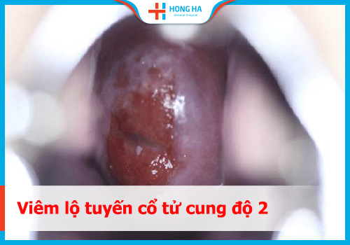 Các triệu chứng của viêm lộ tuyến cổ tử cung độ 2 và cách chữa trị