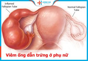 Viêm ống dẫn trứng: nguyên nhân, triệu chứng và cách phòng ngừa