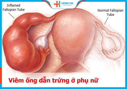 Viêm ống dẫn trứng: nguyên nhân, triệu chứng và cách phòng ngừa