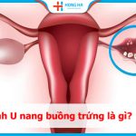 U nang buồng trứng: Nguyên nhân, triệu chứng và các phương pháp điều trị
