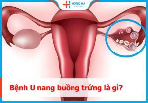 U nang buồng trứng: Nguyên nhân, triệu chứng và các phương pháp điều trị