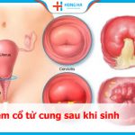 80% trường hợp viêm cổ tử cung sau sinh có thể được phòng ngừa