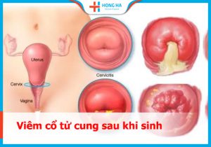 80% trường hợp viêm cổ tử cung sau sinh có thể được phòng ngừa