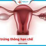 Giải đáp về vòi trứng thông hạn chế: Nguyên nhân, triệu chứng và điều trị