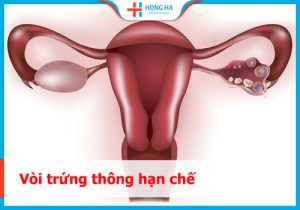 Giải đáp về vòi trứng thông hạn chế: Nguyên nhân, triệu chứng và điều trị