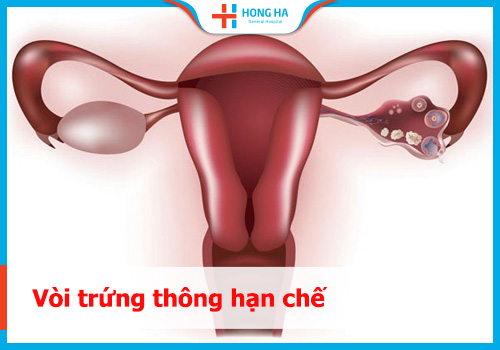 Giải đáp về vòi trứng thông hạn chế: Nguyên nhân, triệu chứng và điều trị