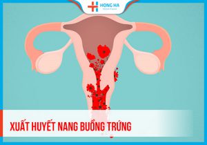 Xuất huyết nang buồng trứng: 10% phụ nữ gặp phải vấn đề này