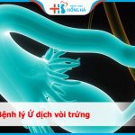 Nguyên nhân và cách điều trị ứ dịch vòi trứng hiệu quả