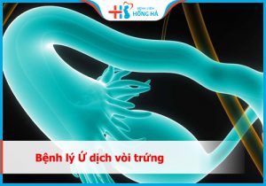 Nguyên nhân và cách điều trị ứ dịch vòi trứng hiệu quả