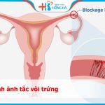 Tắc vòi trứng: Nguyên nhân, triệu chứng và phương pháp điều trị hiệu quả