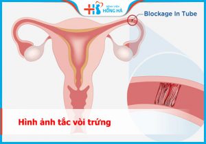 Tắc vòi trứng: Nguyên nhân, triệu chứng và phương pháp điều trị hiệu quả