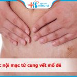 Quá trình phục hồi sau phẫu thuật mổ đẻ lạc nội mạc tử cung