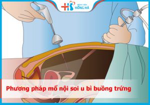Mổ nội soi u bì buồng trứng – Thông tin chi tiết và kinh nghiệm hữu ích