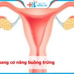Nang cơ năng buồng trứng là gì? Bị nang bên trái hoặc phải xử lý thế nào?