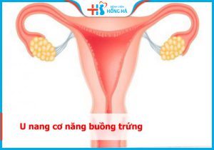 Nang cơ năng buồng trứng là gì? Bị nang bên trái hoặc phải xử lý thế nào?