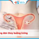Nang đơn thùy buồng trứng: Nguyên nhân, triệu chứng và điều trị hiệu quả