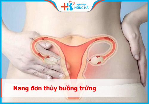 Nang đơn thùy buồng trứng: Nguyên nhân, triệu chứng và điều trị hiệu quả