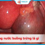 Nang nước buồng trứng ở phụ nữ: 10% phụ nữ mắc phải và cách phòng tránh