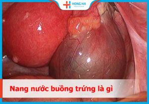 Nang nước buồng trứng ở phụ nữ: 10% phụ nữ mắc phải và cách phòng tránh
