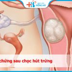 Biến chứng sau chọc hút trứng như thế nào? Cùng chuyên gia giải đáp