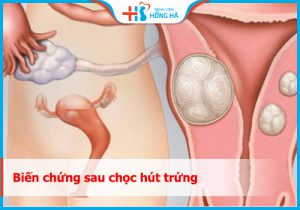 Biến chứng sau chọc hút trứng như thế nào? Cùng chuyên gia giải đáp