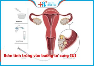 Phương pháp bơm tinh trùng vào buồng tử cung IUI là gì? Quy trình ra sao?