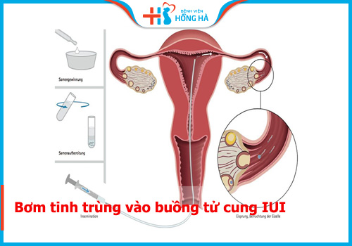 Bơm tinh trùng (IUI) là gì? 6 bước CHUẨN trong quy trình bơm IUI