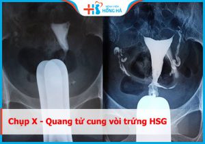 Chụp tử cung vòi trứng: Quy trình chuẩn đoán và điều trị các vấn đề phụ khoa