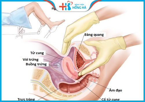 chụp tử cung vòi trứng khi nào