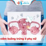 Bảo vệ sức khỏe phụ nữ: Tránh được 80% viêm buồng trứng