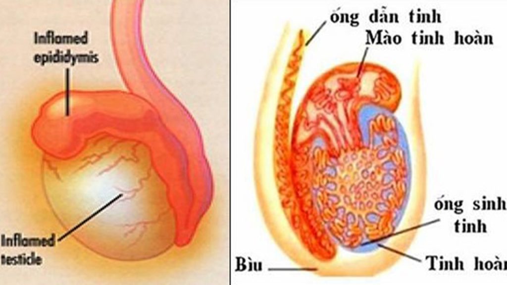 Viêm mào tinh hoàn ở trẻ em: Nguyên nhân, triệu chứng và điều trị