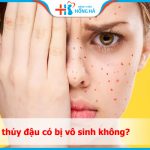 Người bị bệnh thủy đậu có bị vô sinh không? Giải đáp nhanh