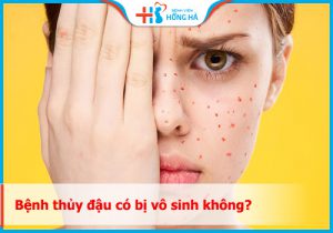 Người bị bệnh thủy đậu có bị vô sinh không? Giải đáp nhanh
